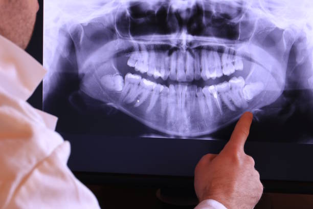 Best Emergency Dentist for Lost Fillings or Crowns in Pelion, SC